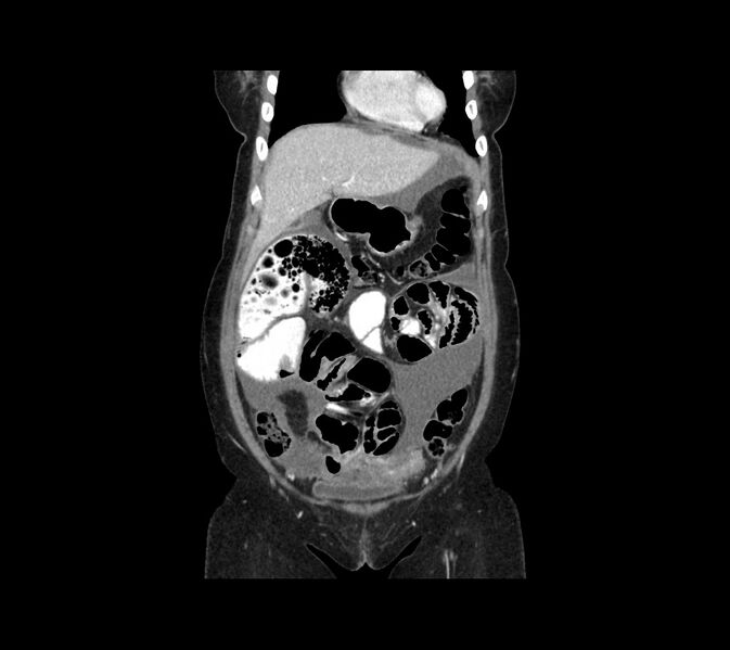 File:Cocoon abdomen with possible tubo-ovarian abscess (Radiopaedia 46235-50636 B 13).jpg
