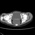 Colocolic fistula - Crohn disease (Radiopaedia 57063-63955 A 88).jpg