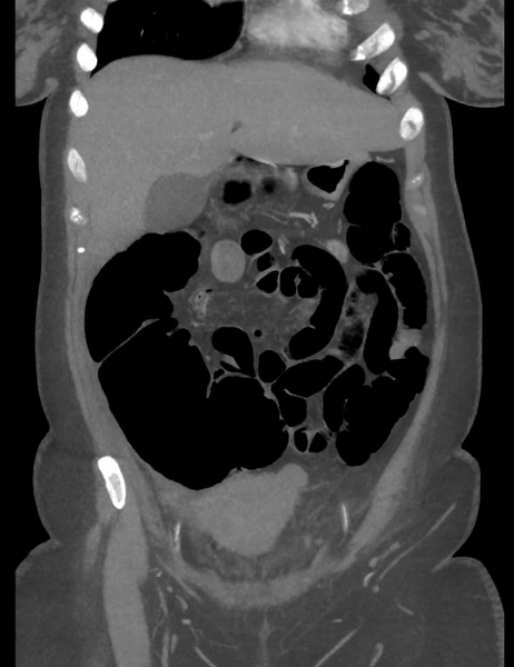 File:Colonic pseudo-obstruction (Radiopaedia 79752-92980 B 23).png