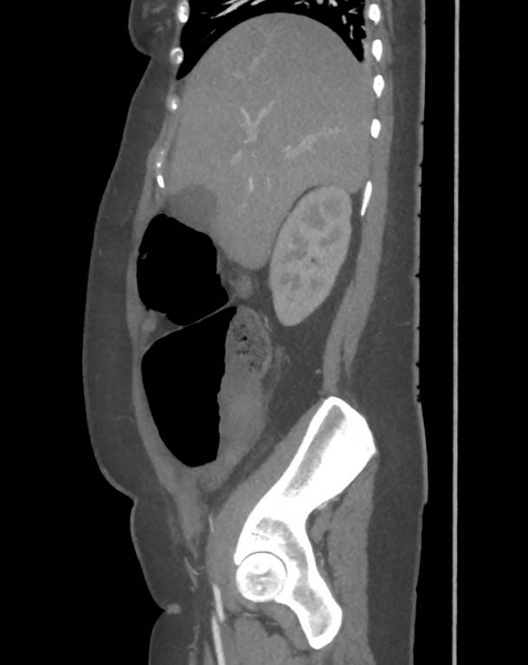 File:Colonic pseudo-obstruction (Radiopaedia 79752-92980 C 24).png