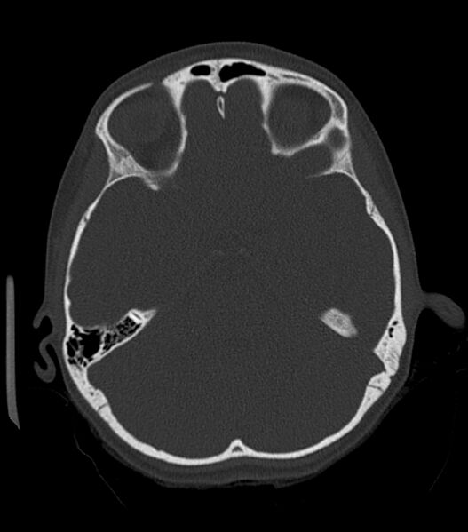 File:Nasoorbitoethmoid fracture (Radiopaedia 90044-107205 Axial bone window 90).jpg