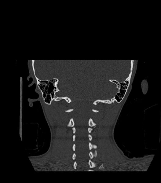 File:Nasoorbitoethmoid fracture (Radiopaedia 90044-107205 Coronal bone window 117).jpg