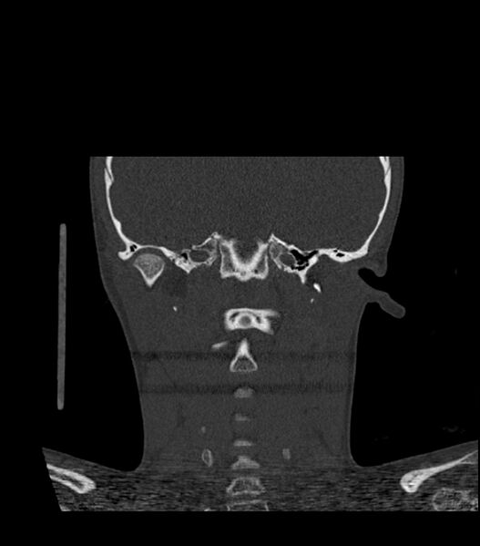 File:Nasoorbitoethmoid fracture (Radiopaedia 90044-107205 Coronal bone window 95).jpg