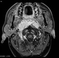 Nasopharyngeal carcinoma (Radiopaedia 4546-6667 Axial T1 C+ fat sat 11).jpg