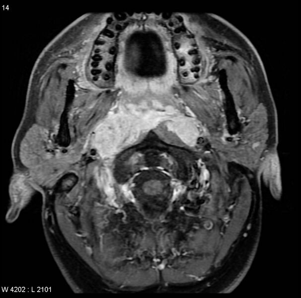 File:Nasopharyngeal carcinoma (Radiopaedia 4546-6667 Axial T1 C+ fat sat 11).jpg