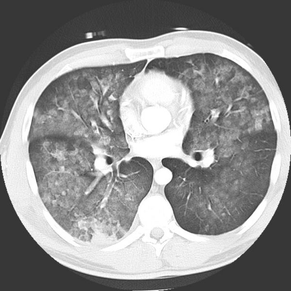 File:Near drowning pulmonary edema (Radiopaedia 16868-16591 Axial lung window 26).jpg