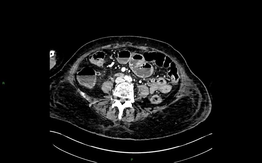 Neo-terminal ileal stricture (Crohn disease) (Radiopaedia 33790-34948 A 265).jpg