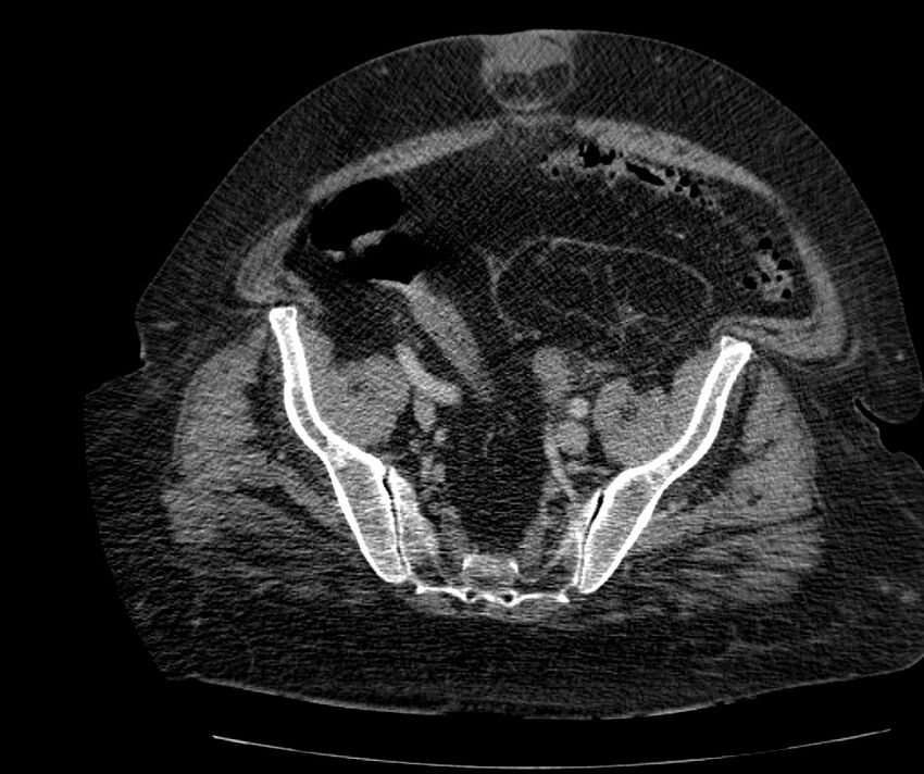 Nephroptosis with inguinal hernia containing perirenal fat (Radiopaedia 56632-63391 C 273).jpg