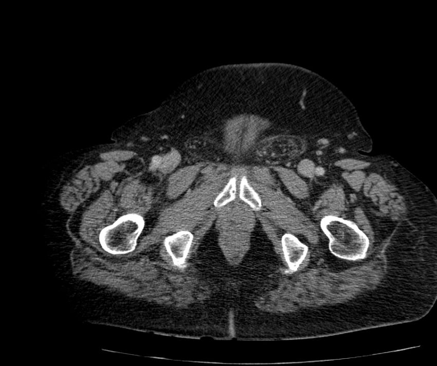 Nephroptosis with inguinal hernia containing perirenal fat (Radiopaedia 56632-63391 C 337).jpg