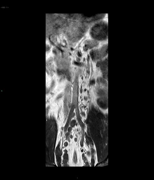 File:Neurofibromatosis type 1 (Radiopaedia 36933-38560 E 1).jpg