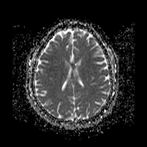 File:Neurofibromatosis type 2 (Radiopaedia 67470-76871 Axial ADC 15).jpg