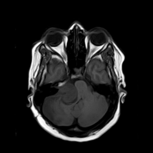 File:Neurofibromatosis type 2 (Radiopaedia 67470-76871 Axial T1 6).jpg