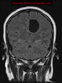 Neuroglial cyst (Radiopaedia 10713-11184 Coronal FLAIR 11).jpg