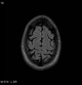 Neurosarcoidosis (Radiopaedia 10930-17204 Axial FLAIR 18).jpg