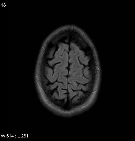 File:Neurosarcoidosis (Radiopaedia 10930-17204 Axial FLAIR 18).jpg