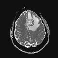 Neurotoxoplasmosis - concentric target sign (Radiopaedia 70644-80784 Axial ADC 17).jpg