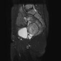 Non-puerperal uterine inversion (Radiopaedia 78343-90983 Sagittal T2 fat sat 8).jpg
