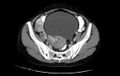 Non-puerperal uterine inversion (Radiopaedia 78343-91094 A 2).jpg