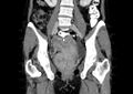 Non-puerperal uterine inversion (Radiopaedia 78343-91094 B 14).jpg