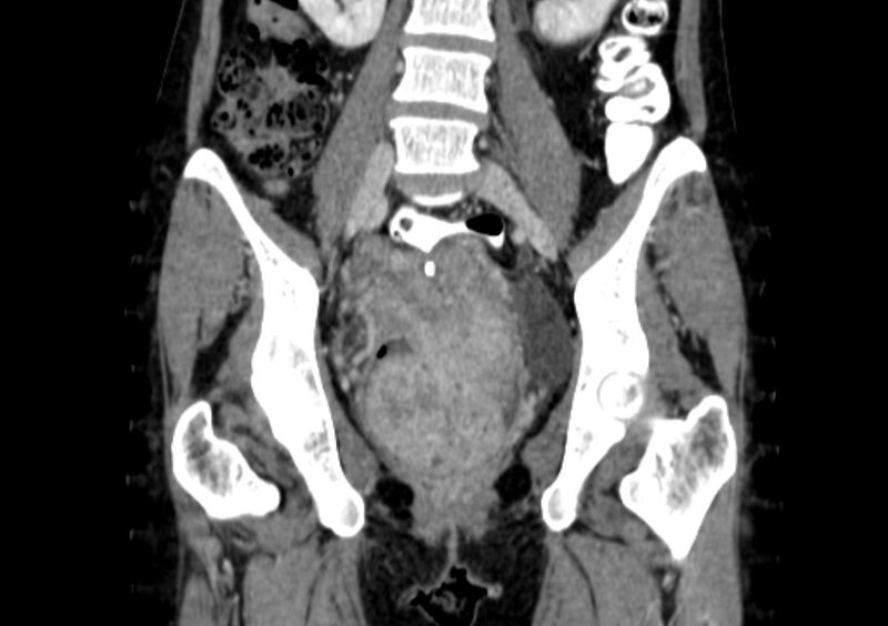 File:Non-puerperal uterine inversion (Radiopaedia 78343-91094 B 14).jpg