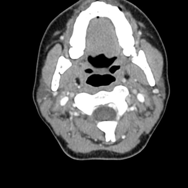 File:Normal CT of the neck (Radiopaedia 14575-14500 Axial C+ 26).jpg