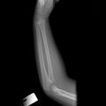 Normal elbow x-ray - 5-year-old (Radiopaedia 53080-59040 Lateral 1).jpg