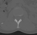 Normal lumbar spine CT (Radiopaedia 46533-50986 Axial bone window 17).png