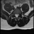 Normal lumbar spine MRI (Radiopaedia 35543-37039 Axial T2 11).png