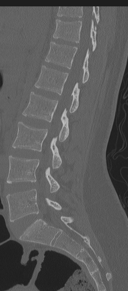 File:Normal lumbosacral CT (Radiopaedia 37923-39867 Sagittal bone window 54).png