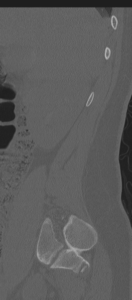 File:Normal lumbosacral CT (Radiopaedia 37923-39867 Sagittal bone window 86).png