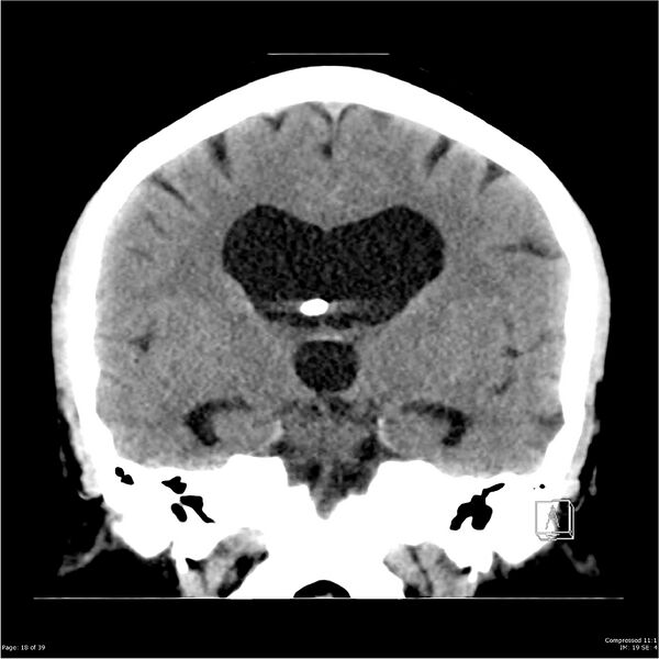 File:Normal pressure hydrocephalus (Radiopaedia 24415-24736 Coronal non-contrast 14).jpg