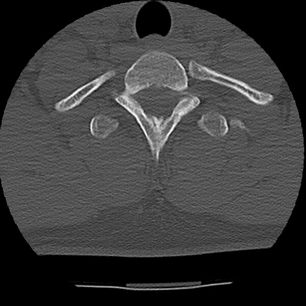 File:Normal trauma spine imaging (Radiopaedia 31753-32686 Axial bone window 75).jpg