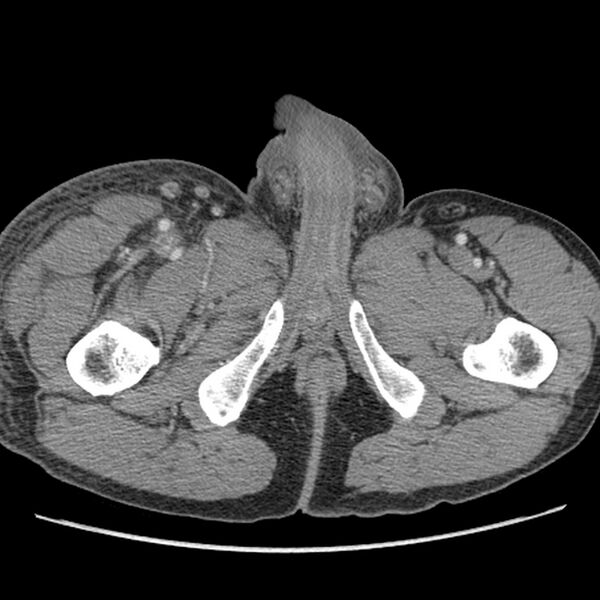 File:Obstructive bladder transitional cell carcinoma (Radiopaedia 9825-10410 A 40).jpg