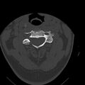 Occipital condyle fracture (Radiopaedia 31755-32691 Axial bone window 29).jpg
