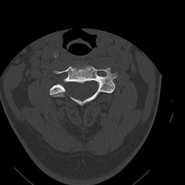 File:Occipital condyle fracture (Radiopaedia 31755-32691 Axial bone window 29).jpg