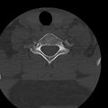 Occipital condyle fracture (Radiopaedia 31755-32691 Axial bone window 66).jpg