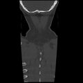 Occipital condyle fracture (Radiopaedia 31755-32691 Coronal bone window 40).jpg