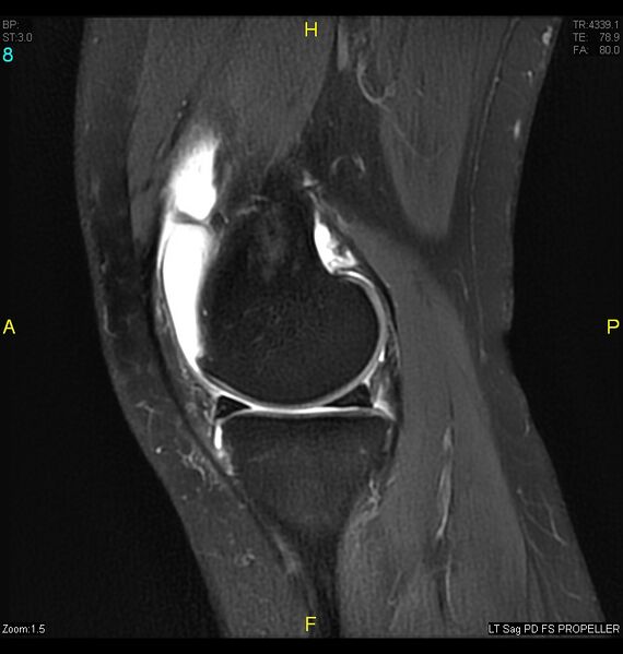 File:ACL mucoid degeration with cystic changes (Radiopaedia 48428-53341 Sagittal PD fat sat 6).jpg