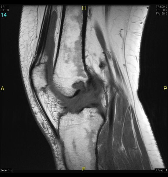 File:ACL mucoid degeration with cystic changes (Radiopaedia 48428-53341 Sagittal T1 12).jpg
