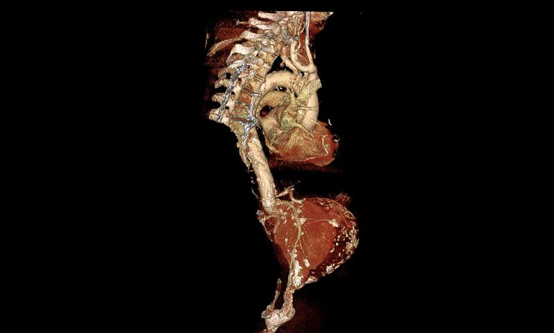File:Abdominal aortic aneurysm- extremely large, ruptured (Radiopaedia 19882-19921 3D 19).jpg