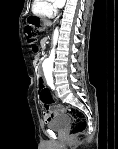 File:Abdominal aortic aneurysm (Radiopaedia 83581-98689 Sagittal C+ arterial phase 46).jpg