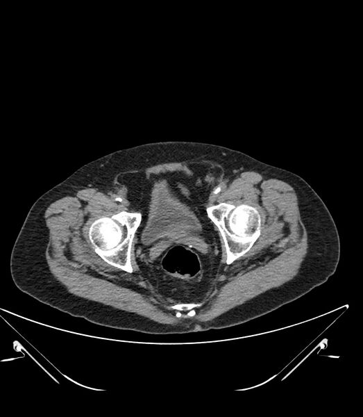 File:Abdominal aortic aneurysm with thrombus fissuration (Radiopaedia 46218-50618 Axial non-contrast 54).jpg