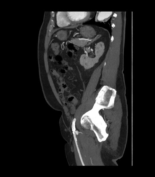 File:Abdominal aortic aneurysm with thrombus fissuration (Radiopaedia 46218-50618 Sagittal C+ arterial phase 41).jpg