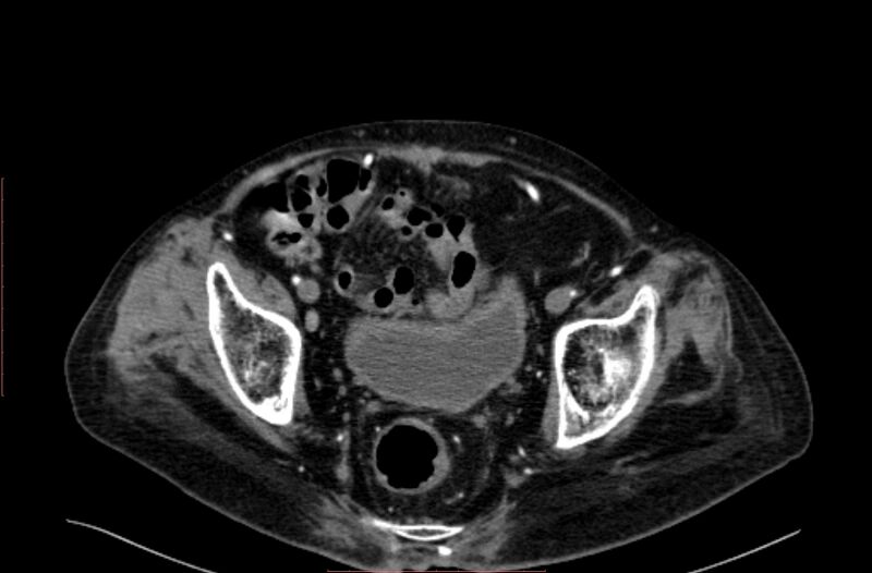 File:Abdominal aortic interposition tube graft and aneurysm thrombosis (Radiopaedia 71438-81857 Axial C+ arterial phase 207).jpg