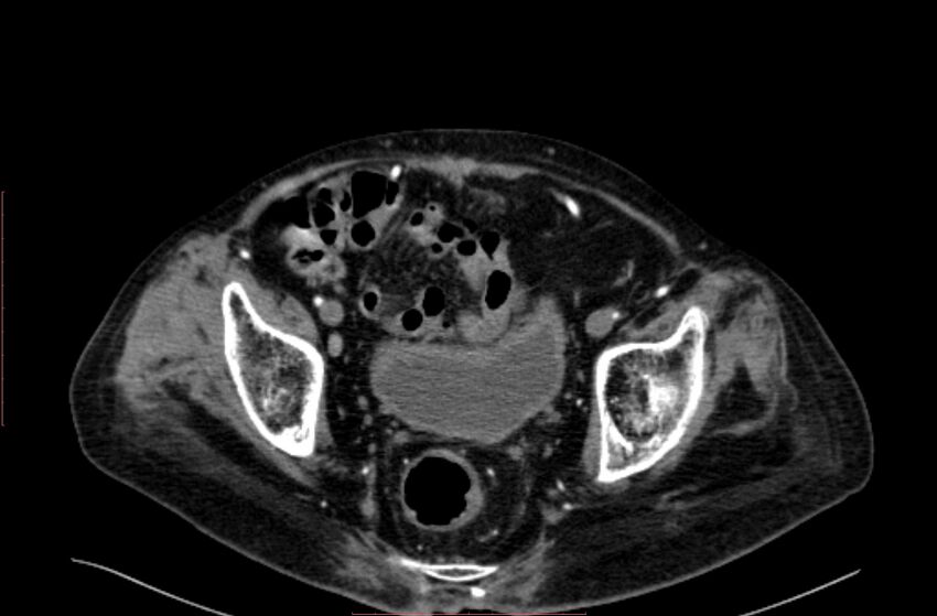 Abdominal aortic interposition tube graft and aneurysm thrombosis (Radiopaedia 71438-81857 Axial C+ arterial phase 207).jpg