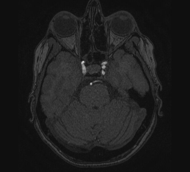 File:Accessory middle cerebral artery and ICA aneurysm (Radiopaedia 22656-22674 MRA 27).jpg