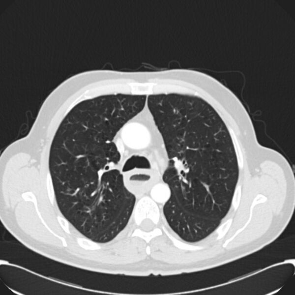 File:Achalasia (Radiopaedia 24937-25206 Axial lung window 12).jpg