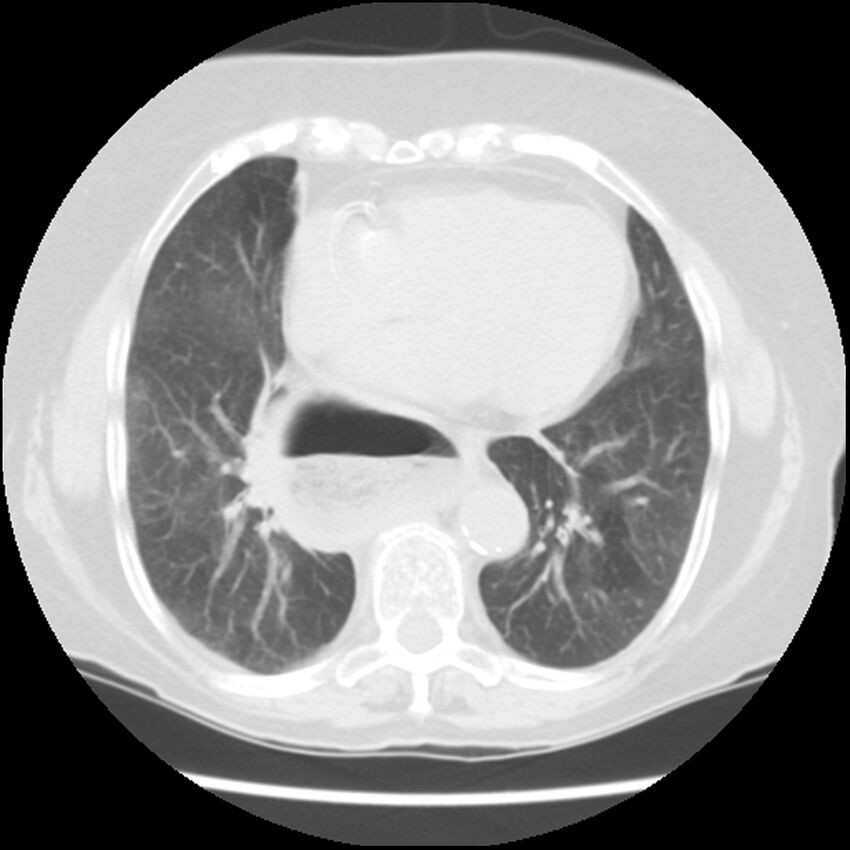 Achalasia (Radiopaedia 44094-47649 Axial lung window 39).jpg