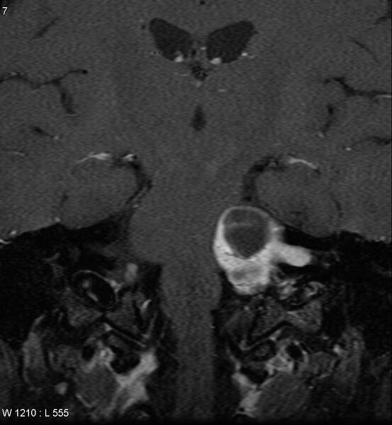 File:Acoustic schwannoma (large with cystic change) (Radiopaedia 5369-7130 Coronal T1 C+ fat sat 4).jpg