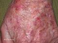 Actinic Keratoses treated with imiquimod (DermNet NZ lesions-ak-imiquimod-3744).jpg